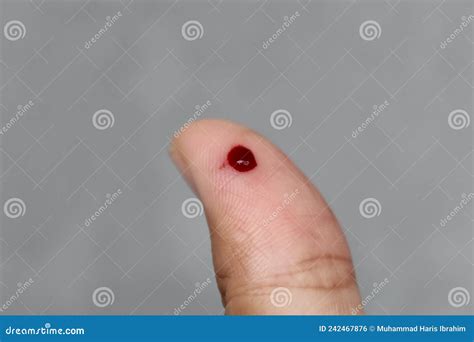 What Does A Blood Clot Feel Like Finger at Jill Deleon blog