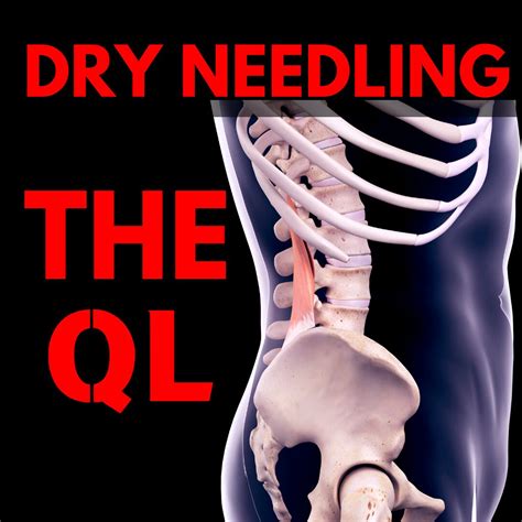 QL Dry Needling in Columbia SC | Low Back Pain Treatment Guide - Vertex ...