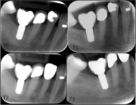 Single implant supported prosthesis viable treatment strategy in female ...