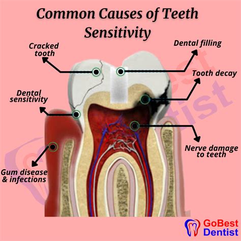 Teeth Sensitivity Treatment - Gobest Dentist