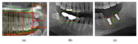 Automatic Tooth Detection and Numbering Using a Combination of a CNN ...