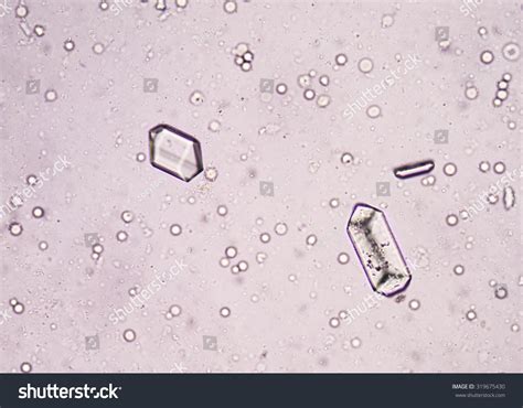 Triple Phosphate Crystal Urine Sediment Stock Photo 319675430 ...