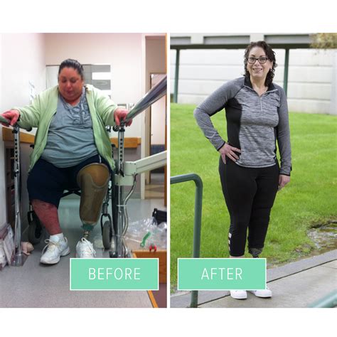 Single Anastomosis Duodenal Switch in Seattle | SIPS/SADI