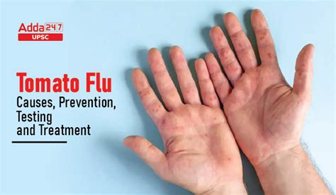 Tomato Flu- Causes, Symptoms, Prevention, and Treatment