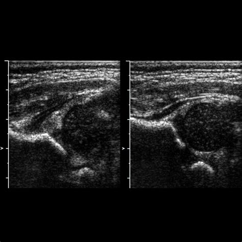 developmental dysplasia of the hip | pacs