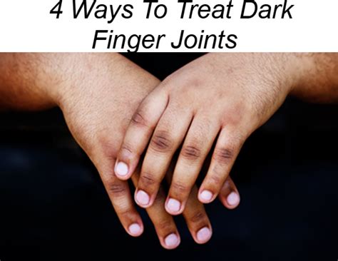 4 Ways To Treat Dark Finger Joints - lifeberrys.com