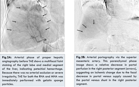 Fatal Hepatic Necrosis after Transcatheter Arterial Embolization for ...