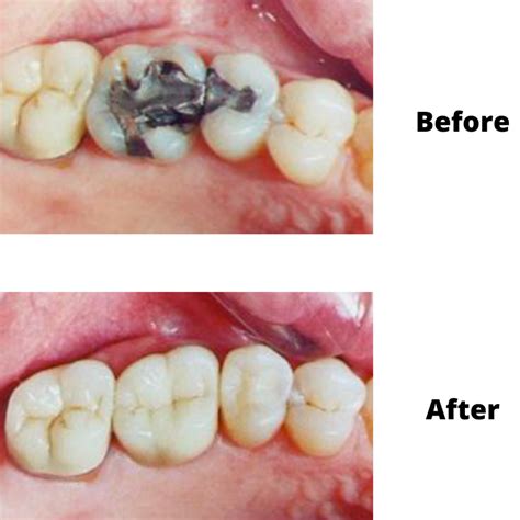 Teeth Filling Services in Cranston RI - Dental RI