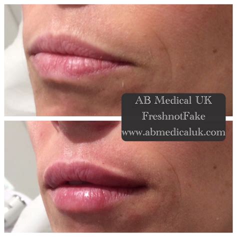 Before and after 0.55ml Juvederm ultra smile | Lip injections, Lip fillers, Lips