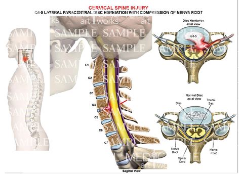 C4-5 disc herniation - paracentral – Medical Art Works