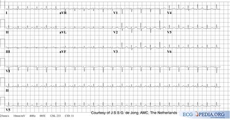 Cardiac tamponade electrocardiogram - wikidoc