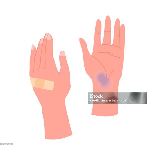 Human Hands With Band Aid Bruise On Palm Two Broken Arms After Injury Accident Damage Stock ...