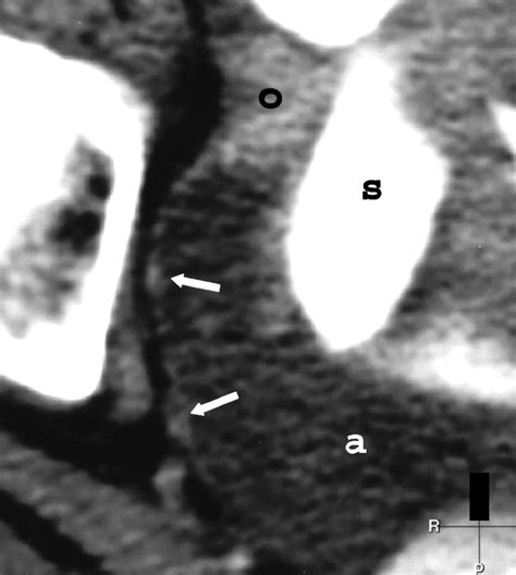 Papillary Serous Adenocarcinoma of the Endometrium: CT–Pathologic Correlation | AJR