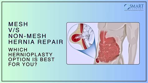 Mesh vs. Non-Mesh: Best Hernia Repair Option | Hernioplasty