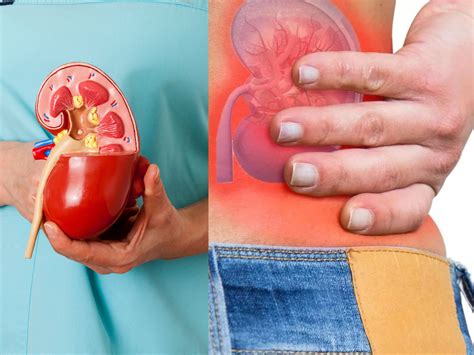 Mumbai doctor warns: Winter can trigger painful kidney stones, 6 ...