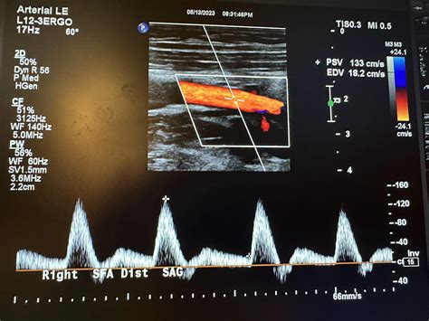 Superficial Femoral Vein Ultrasound