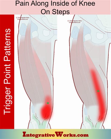 Pain Along Inside of Knee on Steps - Integrative Works