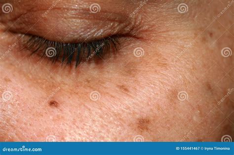 Brown Spots on the Face. Pigmentation on the Skin. Brown Age Spots on the Cheek. Stock Image ...