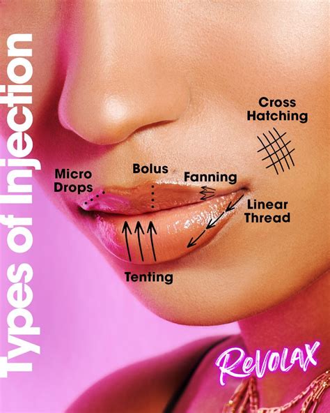 REVOLAX LIP FILLER INJECTION TECHNIQUES 👄 | Dermal fillers, Dermal ...