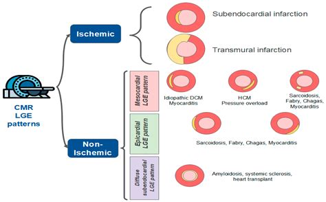 MINOCA: One Size Fits All? Probably Not—A Review of Etiology ...