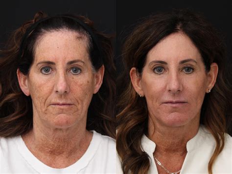CO2 Laser Resurfacing Before and After Pictures Case 428 | Santa Rosa, California | Chernoff ...