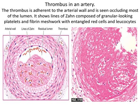 THROMBOSIS | PPTX