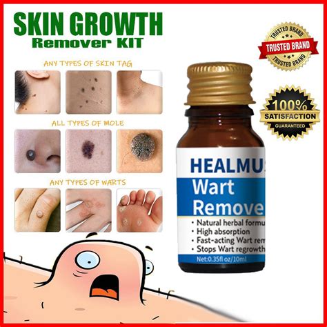 1box 60g New Upgrade Wart Cream Treat Skin Tag Mole Calluses Acne ...