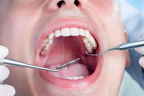 Why Should I Get My Wisdom Teeth Removed? - Athens Oral Surgery Center