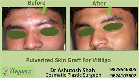 Face Vitiligo Treatment in Navsari, Gujarat