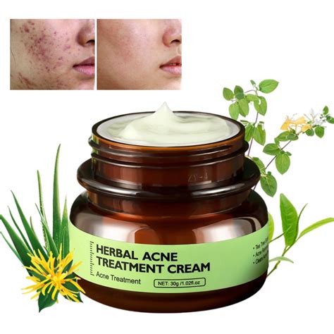 Crema para eliminar el acné Crema antiacné Control de la grasa y reducción de las marcas de acné ...