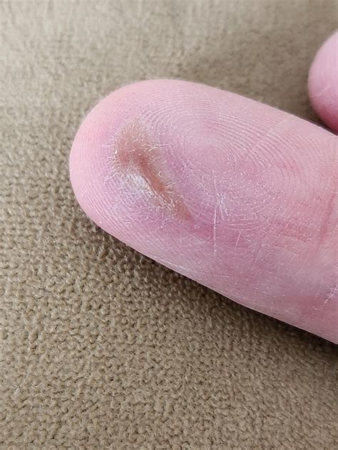 Fluid Filled Bump On Head at Emma Lowell blog