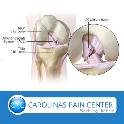 Acute Knee Ligament Tear - Carolinas Pain Center