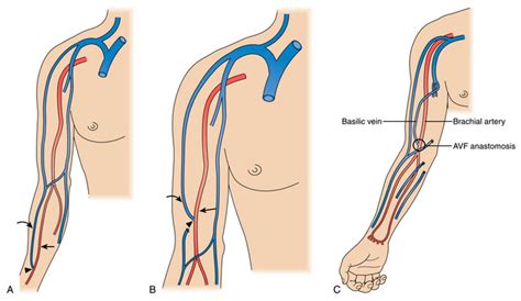 Computational Fluid Dynamics (CFD) in Arteriovenous (AV) Graft ...