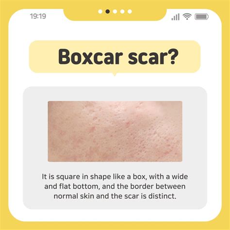 What is boxcar scar? Review of Coratherapy treatment for acne scars at Rodam Korean Medicine ...