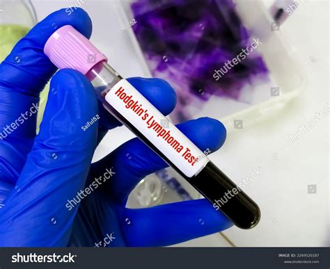 Blood Sample Hodgkins Lymphoma Test Type Stock Photo 2269520187 | Shutterstock
