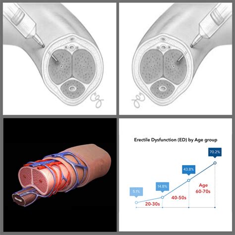 PRF/(P) Penis shot | Vida Skin Beauty Center