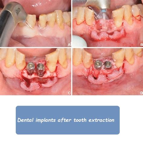 Dental implant abutment types