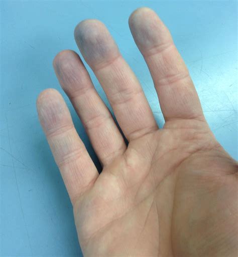 Raynaud Phenomenon - Dermatology - Medbullets Step 2/3