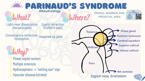 Parinaud Oculoglandular Syndrome