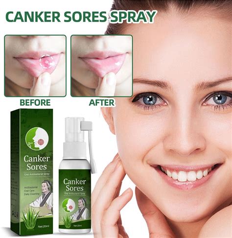 Oral Ulcer Relief Spray 20ml - Canker Sore & Gum Pain Relief Treatment | Buy Now with Express ...