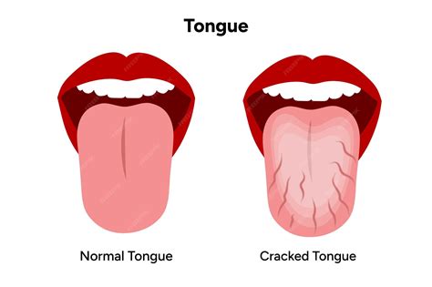 Premium Vector | Cracked tongue problem in human