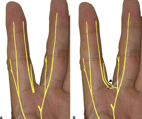Finger Sensory Reconstruction With Transfer of the Proper Digital Nerve ...