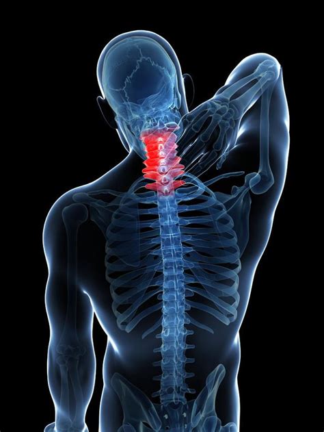 正骨会加重颈椎病、腰椎病、脊柱侧弯，感兴趣可以验证。 - 知乎