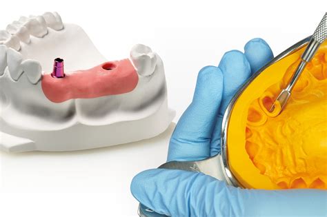 Elastic and rigid impression materials: classification