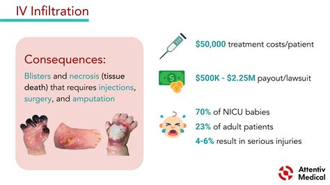 Iv Catheter Infiltration at Susan Cummings blog
