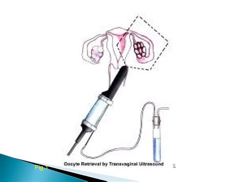 Artificial insemination | PPT