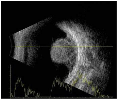Choroidal Melanoma: A Mini Review
