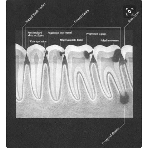 Can an xray show need for root canal? - Dental News Network