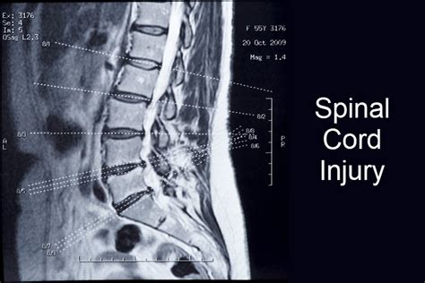 Rezultat imagine pentru Bowel Problems