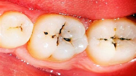 Tooth Cavity: Symptoms, Causes & Treatment